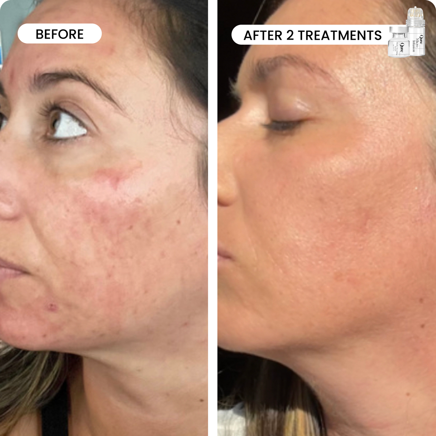 Micro-Infusion 2 Month Bundle (For Dark Spots)