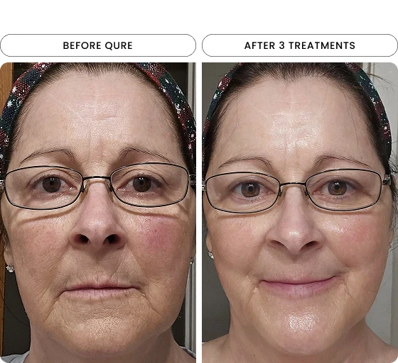 Micro-Infusion 6 Month (For Wrinkles + Dark Spots)