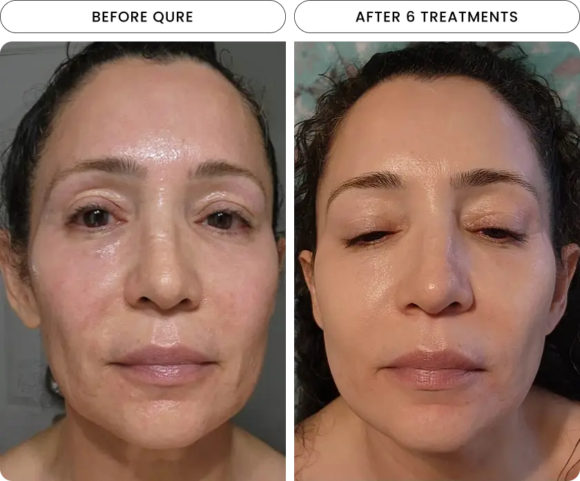 Micro-Infusion 6 Month (For Wrinkles + Dark Spots)