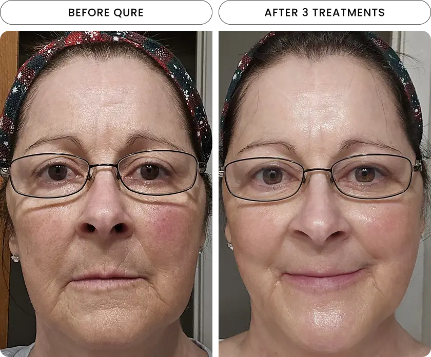Micro-Infusion 6 Month Bundle (For Wrinkles)